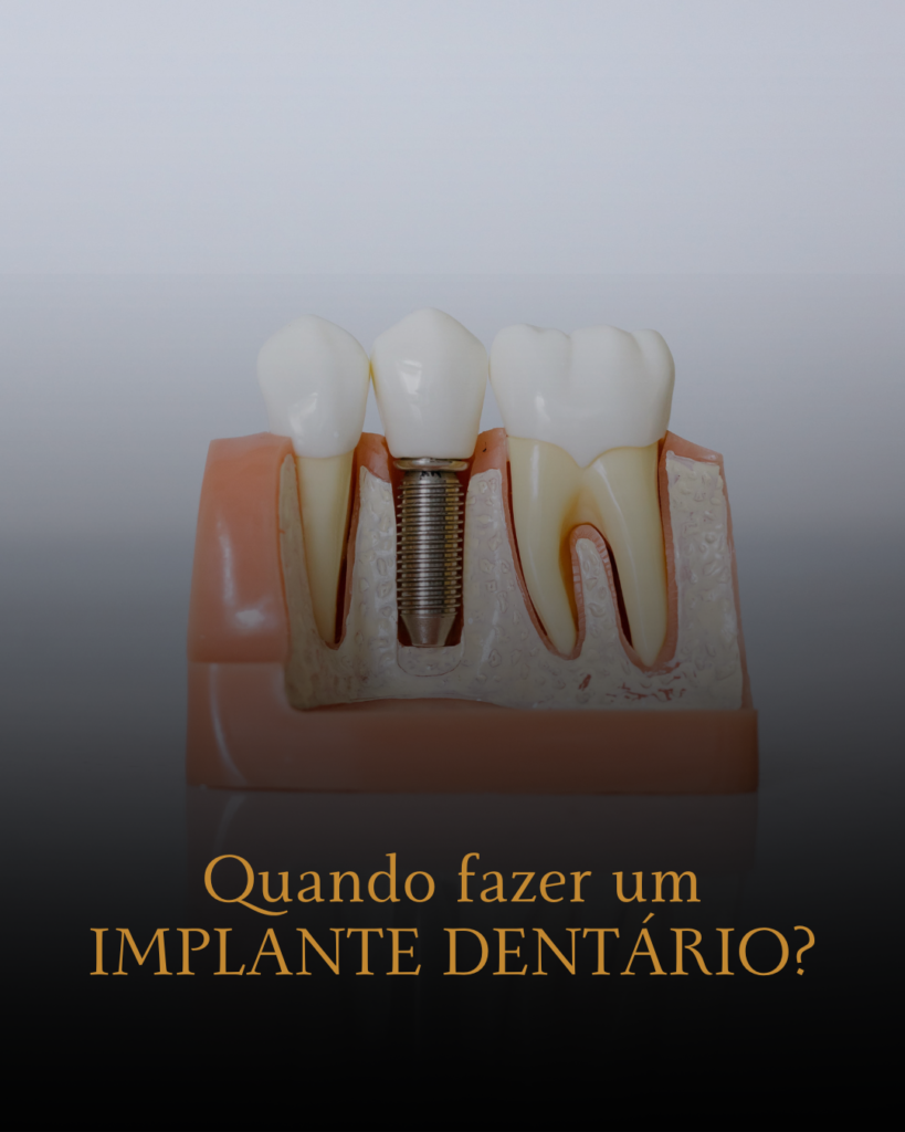 Quando fazer um implante dentário Clínica OdontoBarra